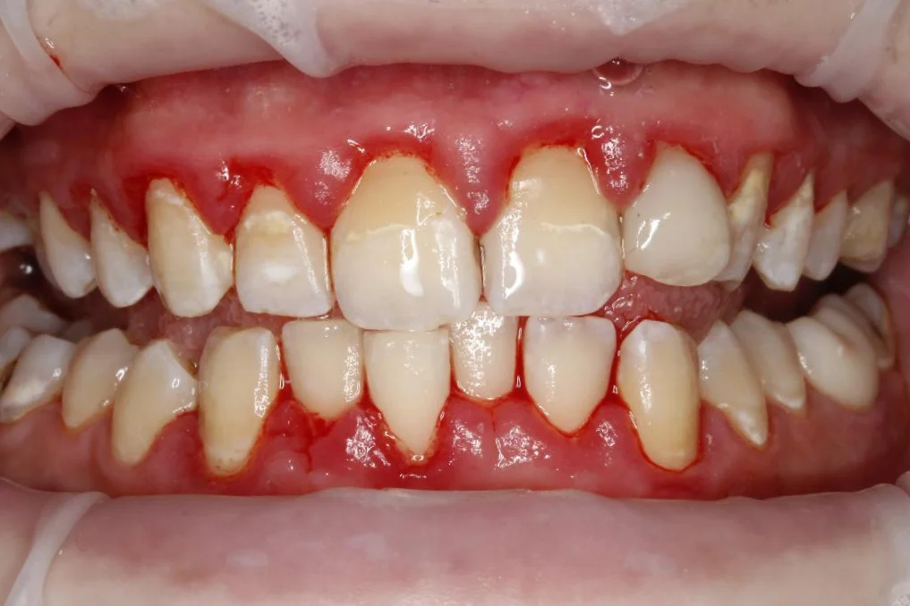 Dentální hygiena