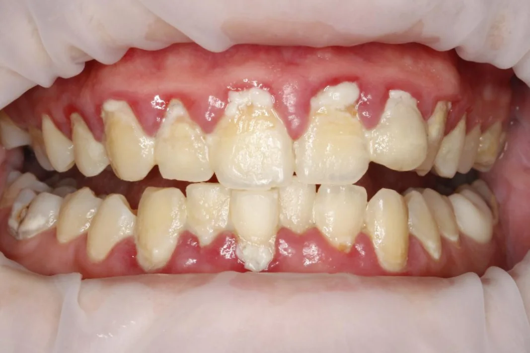 Dentální hygiena