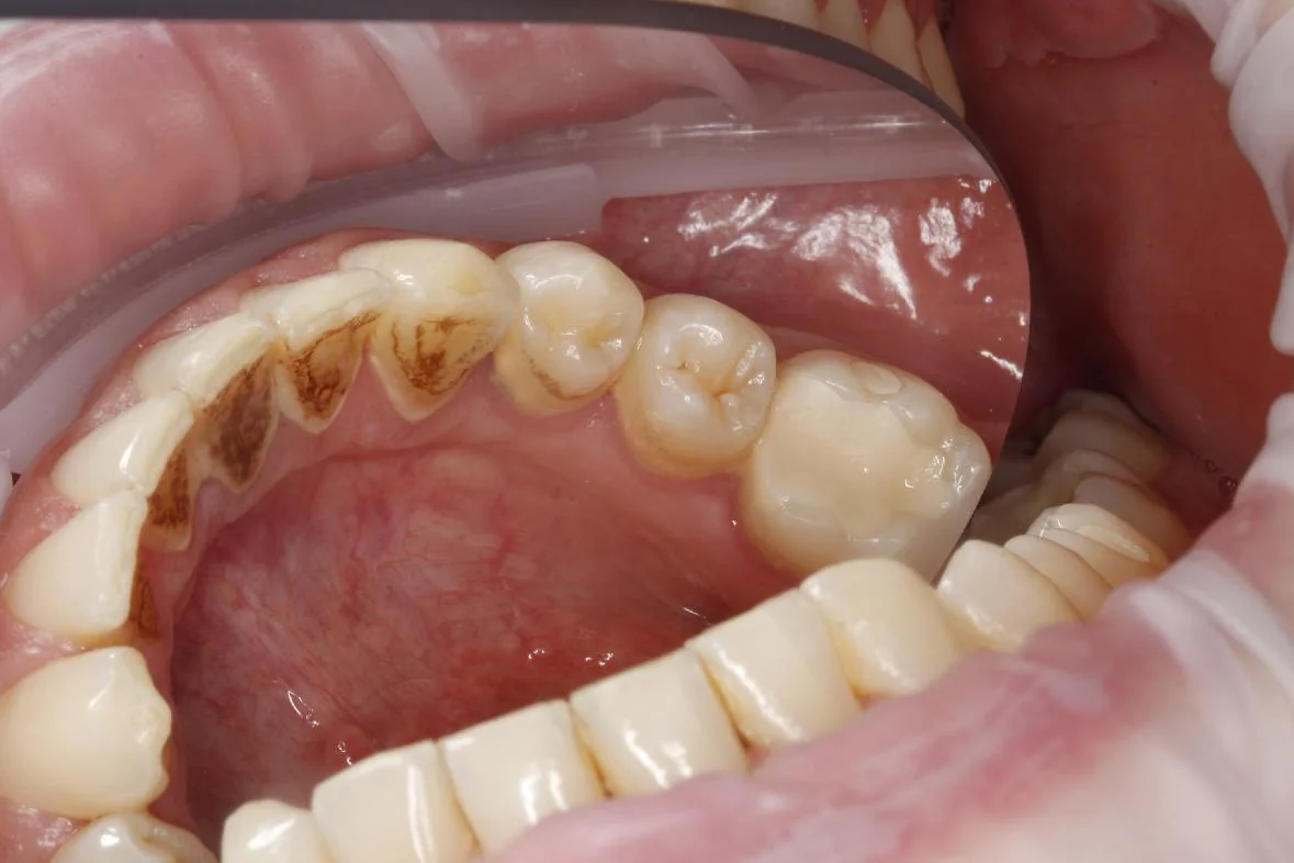 Dentální hygiena