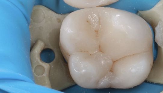 Čištění kanálků (endodoncie)