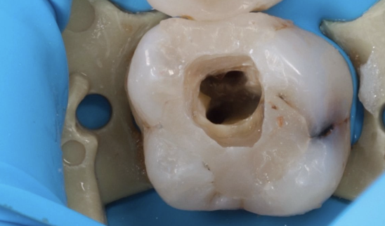 Čištění kanálků (endodoncie)