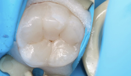 Čištění kanálků (endodoncie)