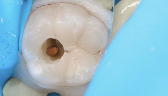 Čištění kanálků (endodoncie)