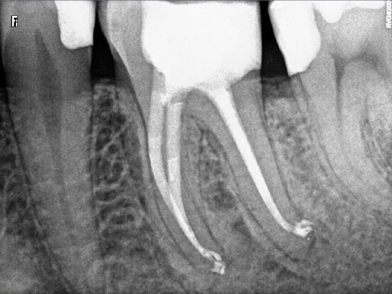 Čištění kanálků (endodoncie)