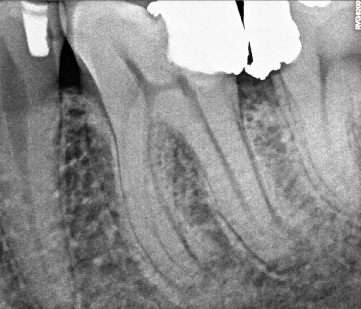 Čištění kanálků (endodoncie)